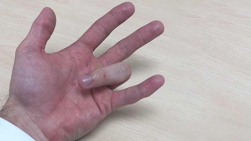 finger pain from golf